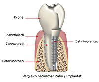 Implantate